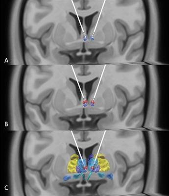 Habenular Stimulation for Neurosurgery Resistant Obsessive-Compulsive Disorder: A Case Report